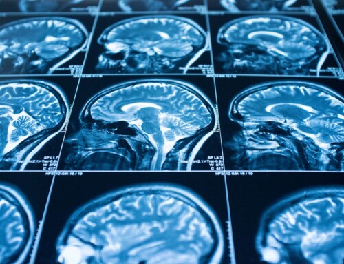 Midlife exercise may help lower Alzheimer’s risk